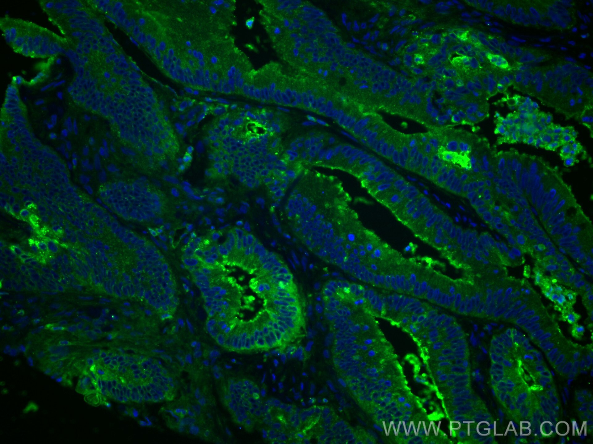 Immunofluorescence (IF) / fluorescent staining of human colon cancer tissue using CEA Polyclonal antibody (10421-1-AP)