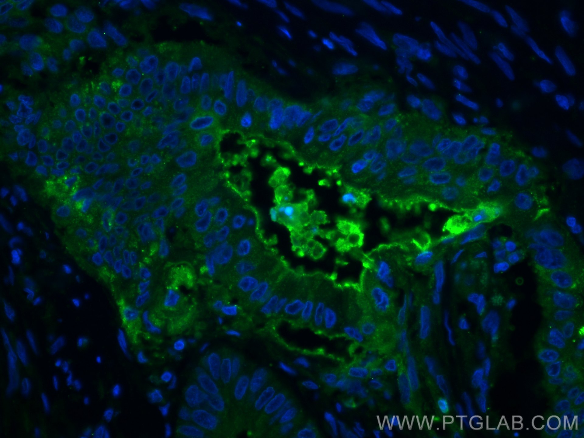 Immunofluorescence (IF) / fluorescent staining of human colon cancer tissue using CEA Polyclonal antibody (10421-1-AP)