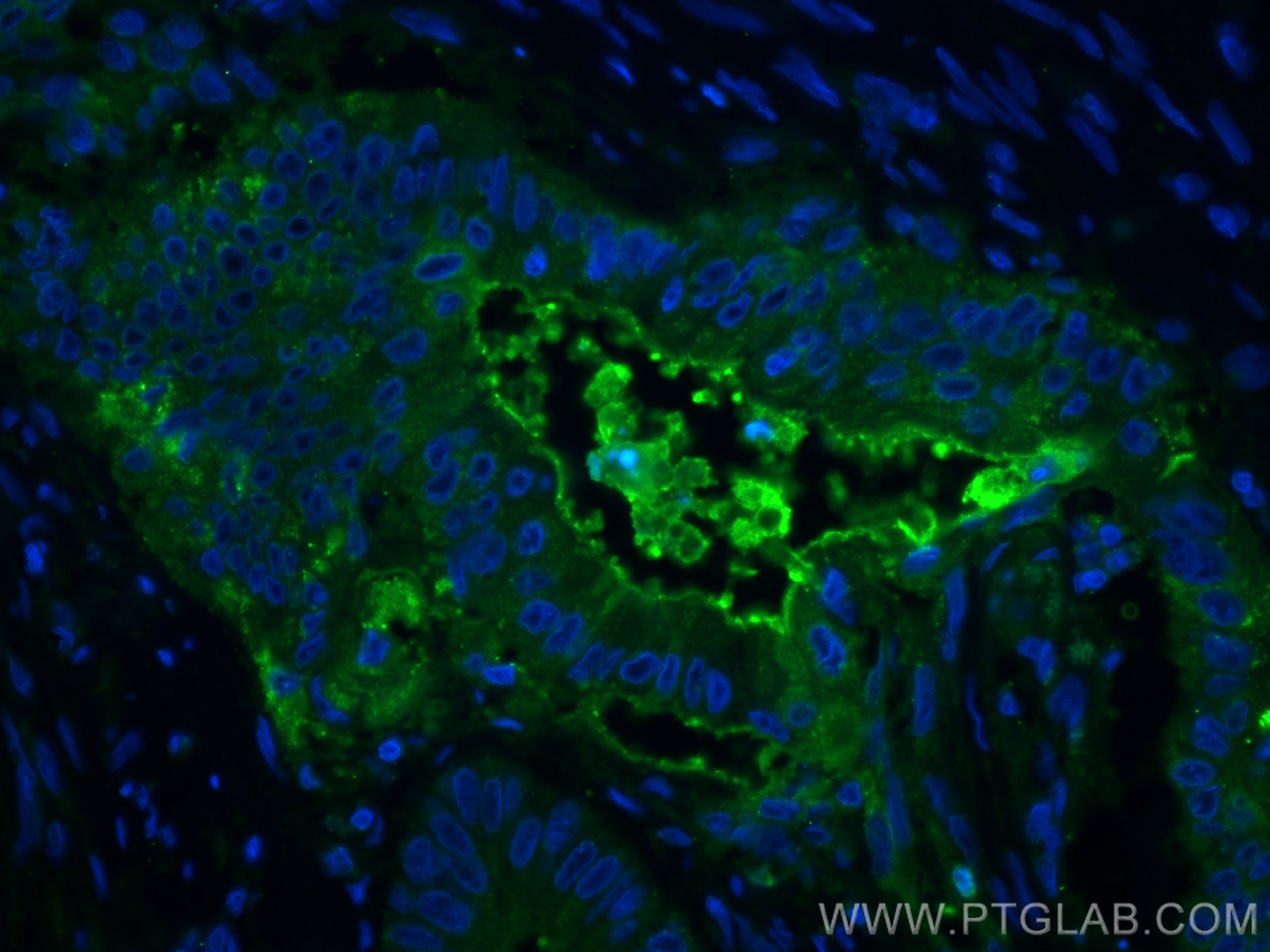 IF Staining of human colon cancer using 10421-1-AP