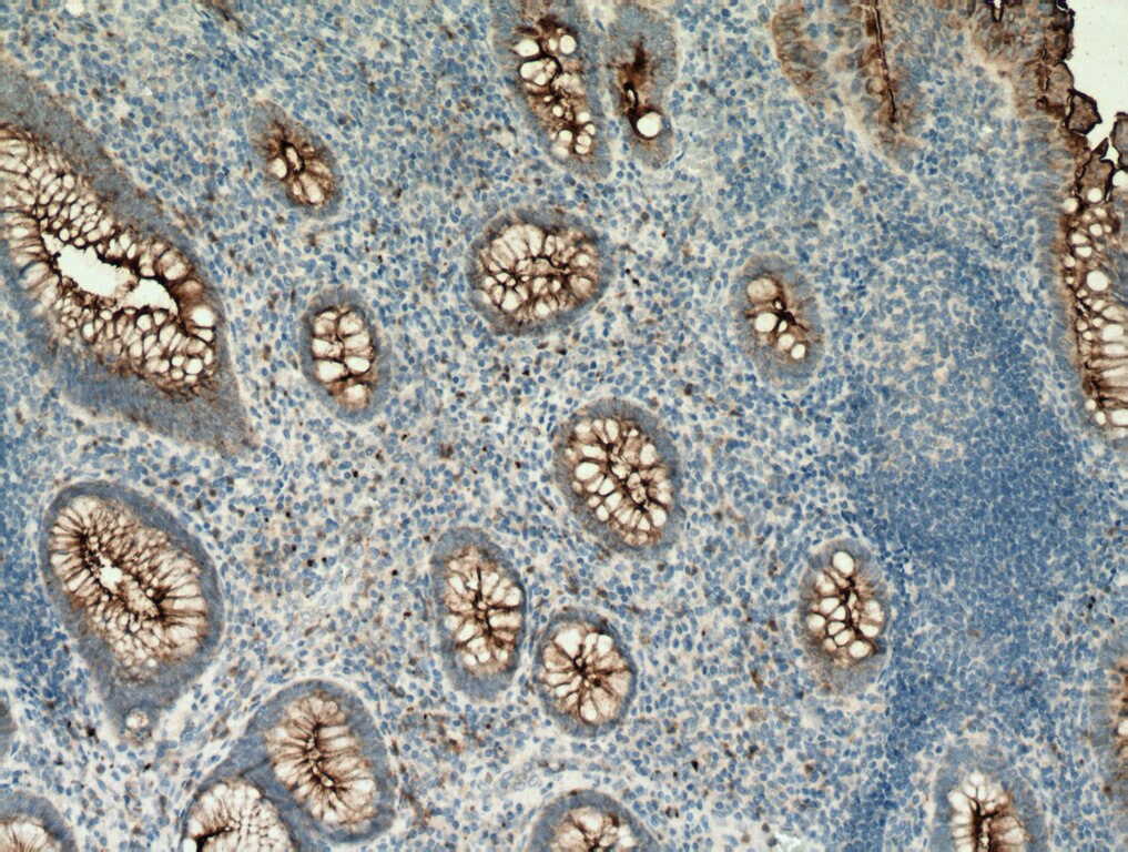 IHC staining of human appendicitis using 10421-1-AP