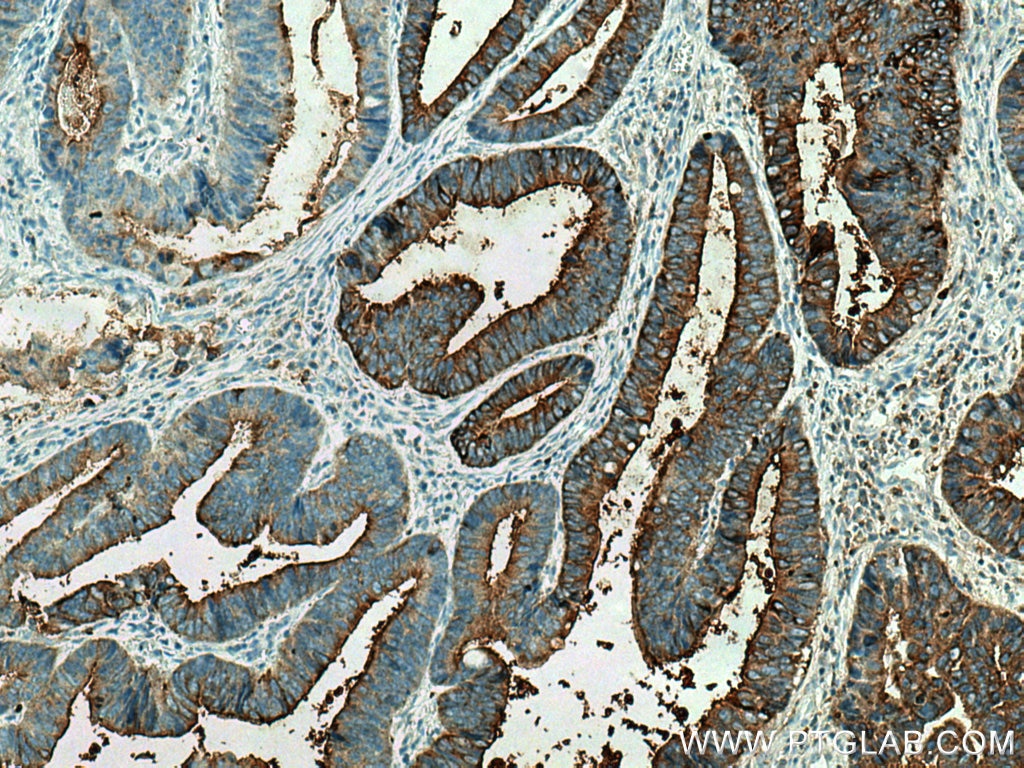 Immunohistochemistry (IHC) staining of human colon cancer tissue using CEA Polyclonal antibody (10421-1-AP)