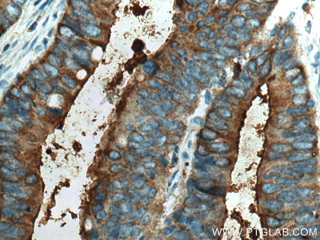 Immunohistochemistry (IHC) staining of human colon cancer tissue using CEA Polyclonal antibody (10421-1-AP)