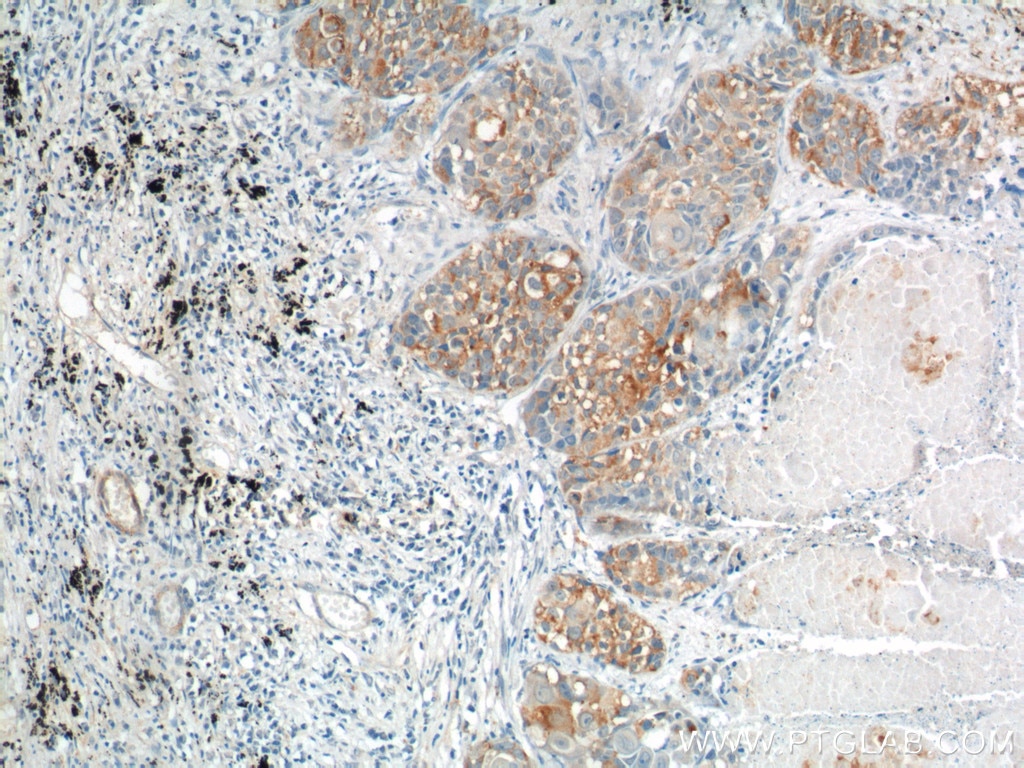 Immunohistochemistry (IHC) staining of human lung cancer tissue using CEA Polyclonal antibody (10421-1-AP)