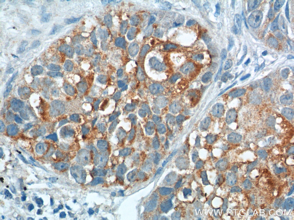 Immunohistochemistry (IHC) staining of human lung cancer tissue using CEA Polyclonal antibody (10421-1-AP)