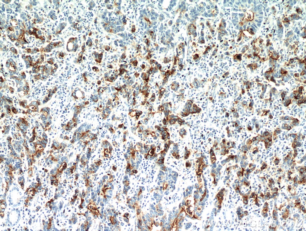 IHC staining of human stomach cancer using 10421-1-AP