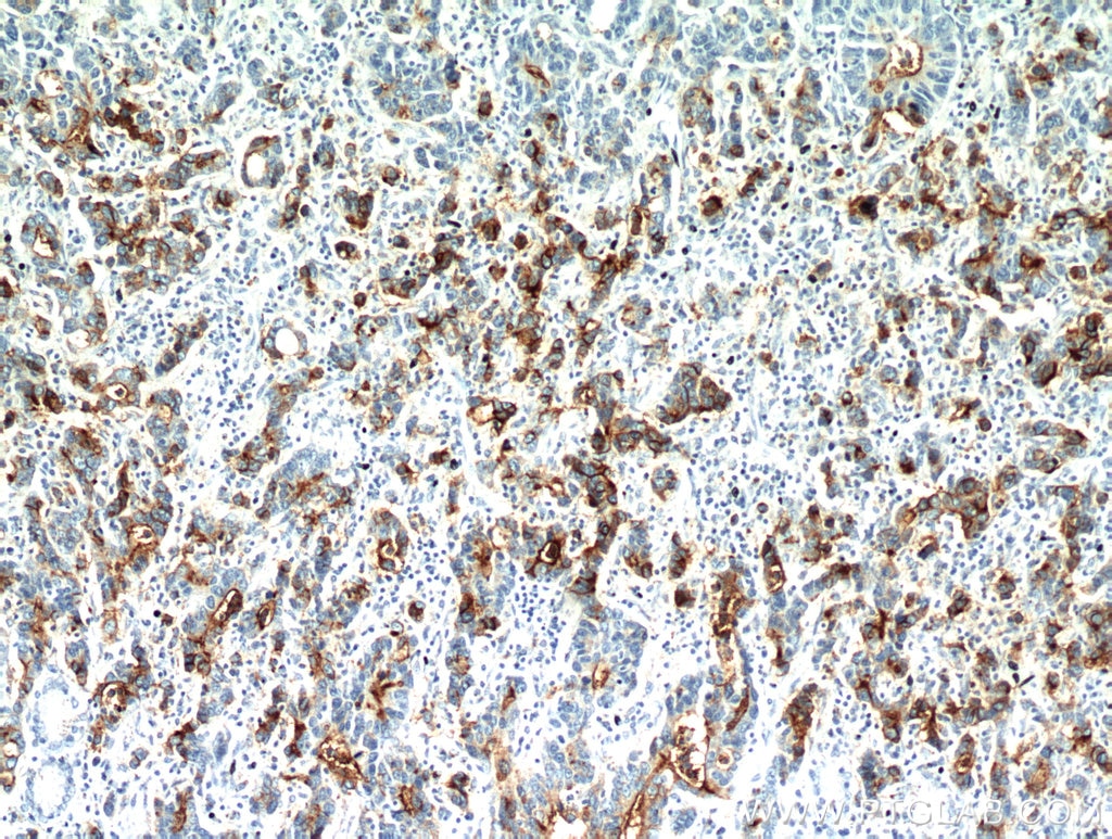 Immunohistochemistry (IHC) staining of human stomach cancer tissue using CEA Polyclonal antibody (10421-1-AP)