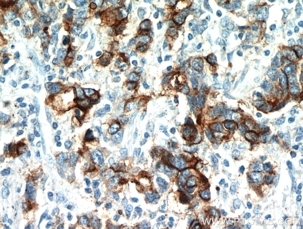 Immunohistochemistry (IHC) staining of human stomach cancer tissue using CEA Polyclonal antibody (10421-1-AP)