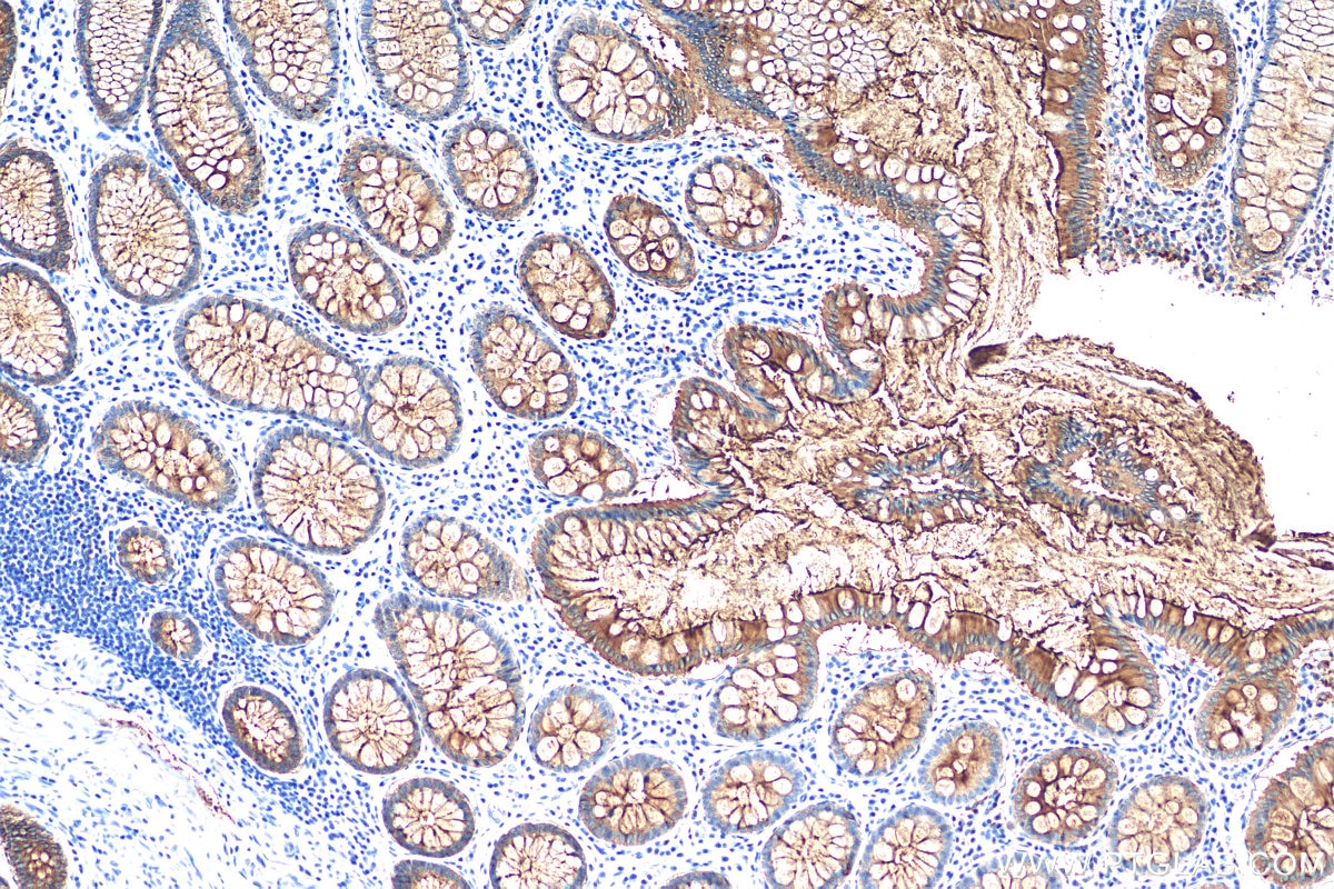 Immunohistochemistry (IHC) staining of human colon cancer tissue using CEA/CD66e Monoclonal antibody (68377-1-Ig)