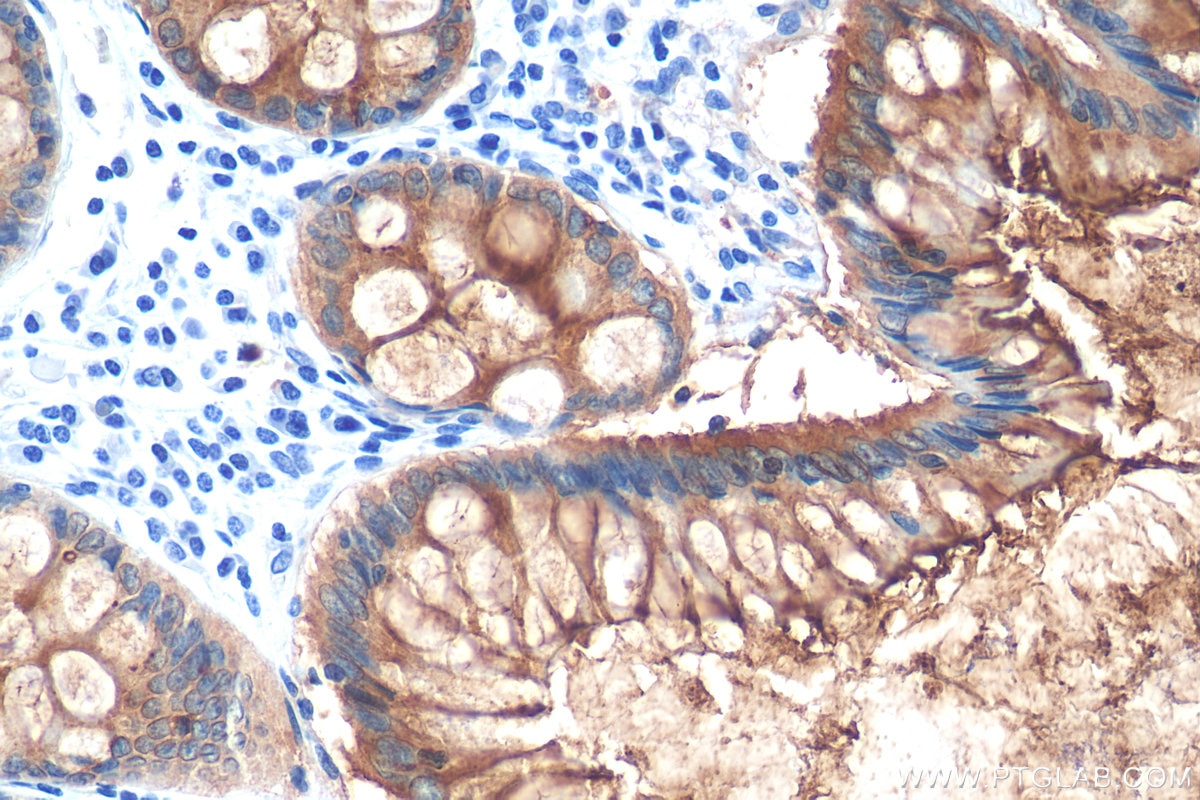 Immunohistochemistry (IHC) staining of human colon cancer tissue using CEA/CD66e Monoclonal antibody (68377-1-Ig)