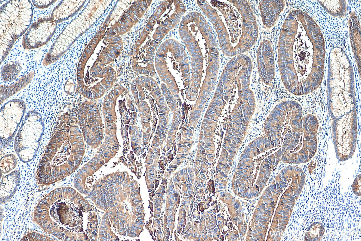 Immunohistochemistry (IHC) staining of human colon cancer tissue using CEA Monoclonal antibody (68377-1-Ig)