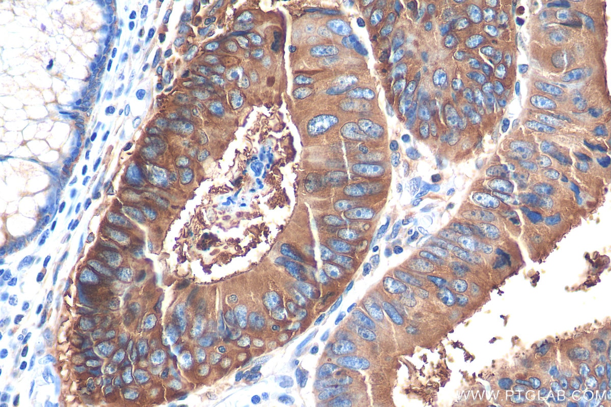 Immunohistochemistry (IHC) staining of human colon cancer tissue using CEA Monoclonal antibody (68377-1-Ig)