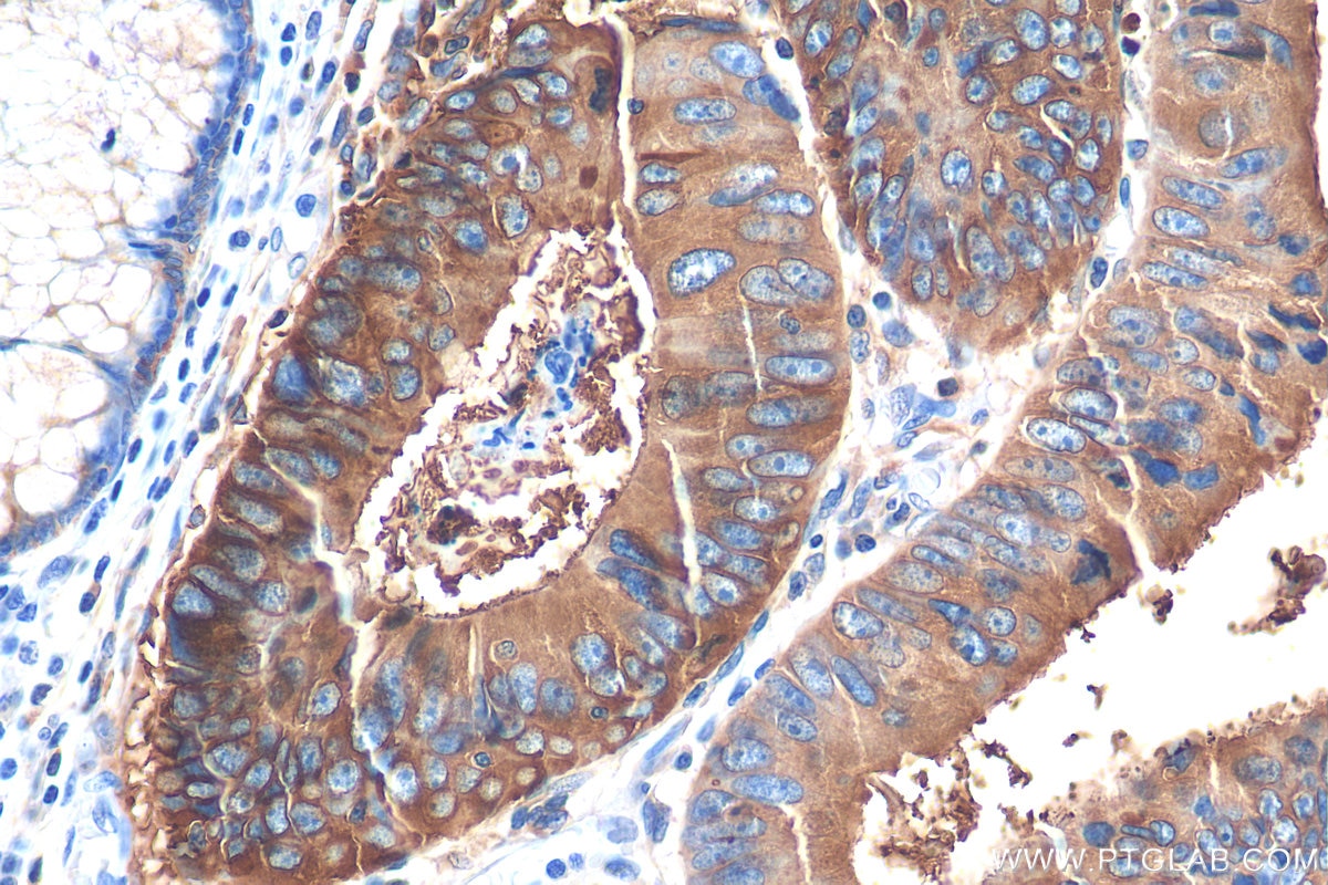 Immunohistochemistry (IHC) staining of human colon cancer tissue using CEA/CD66e Monoclonal antibody (68377-1-Ig)