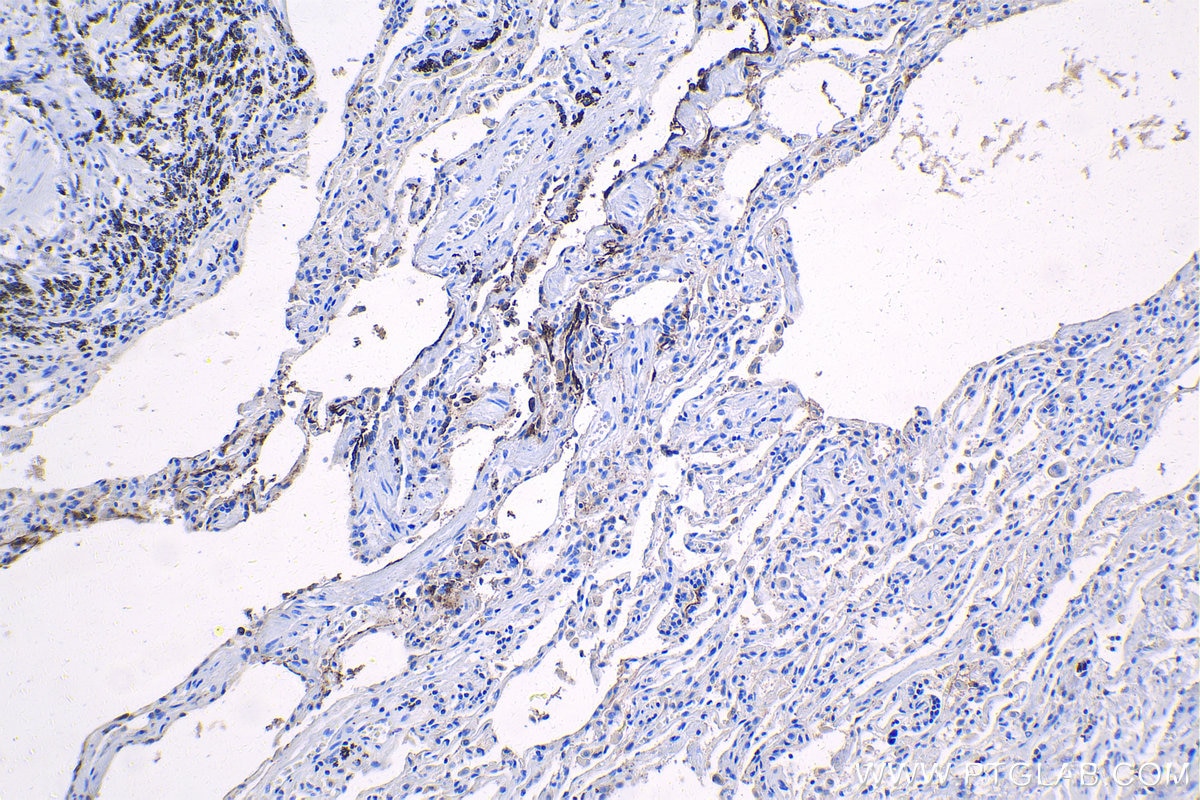 Immunohistochemistry (IHC) staining of human lung tissue using CEA/CD66e Monoclonal antibody (68377-1-Ig)