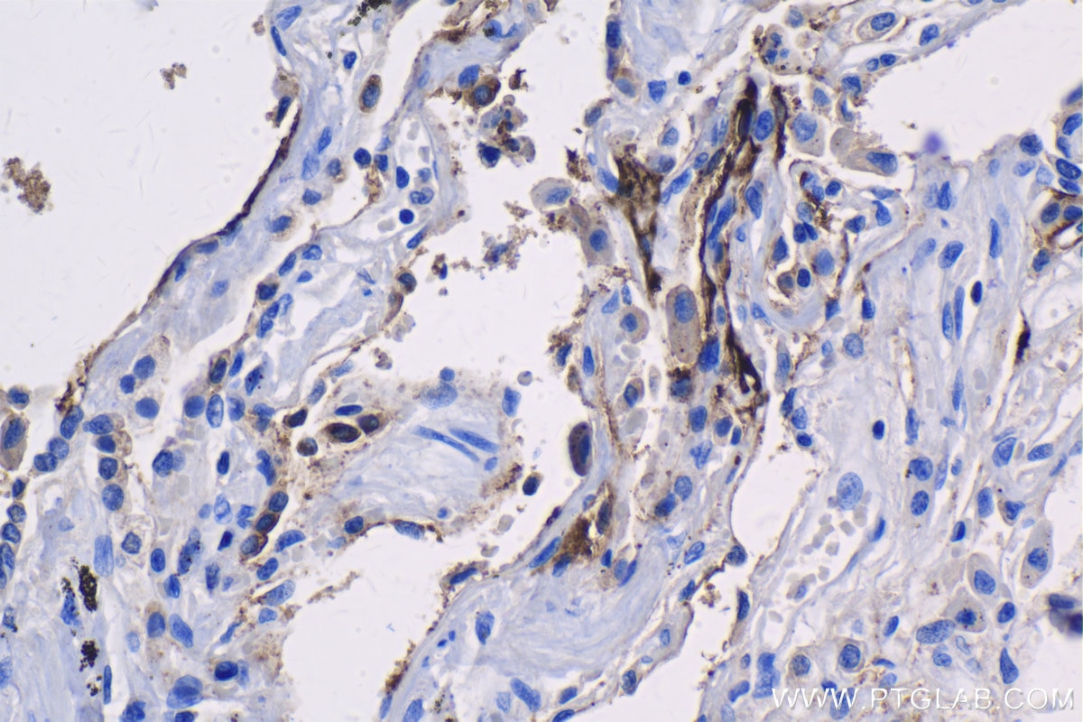Immunohistochemistry (IHC) staining of human lung tissue using CEA/CD66e Monoclonal antibody (68377-1-Ig)