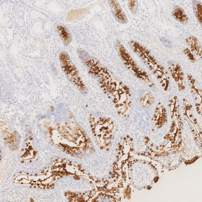 IHC staining of human stomach cancer using 68377-1-Ig Immunohistochemistry (IHC) staining of human stomach cancer tissue using CEA/CD66e Monoclonal antibody (68377-1-Ig)