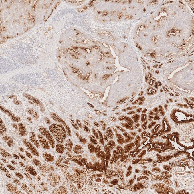 IHC staining of human stomach cancer using 68377-1-Ig Immunohistochemistry (IHC) staining of human stomach cancer tissue using CEA/CD66e Monoclonal antibody (68377-1-Ig)