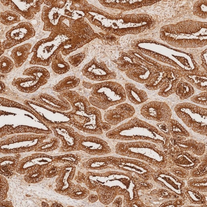 IHC staining of human colorectal cancer using 68377-1-Ig Immunohistochemistry (IHC) staining of human colorectal cancer tissue using CEA/CD66e Monoclonal antibody (68377-1-Ig)
