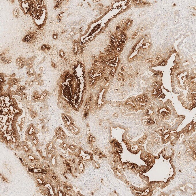 IHC staining of human pancreas cancer using 68377-1-Ig Immunohistochemistry (IHC) staining of human pancreas cancer tissue using CEA/CD66e Monoclonal antibody (68377-1-Ig)