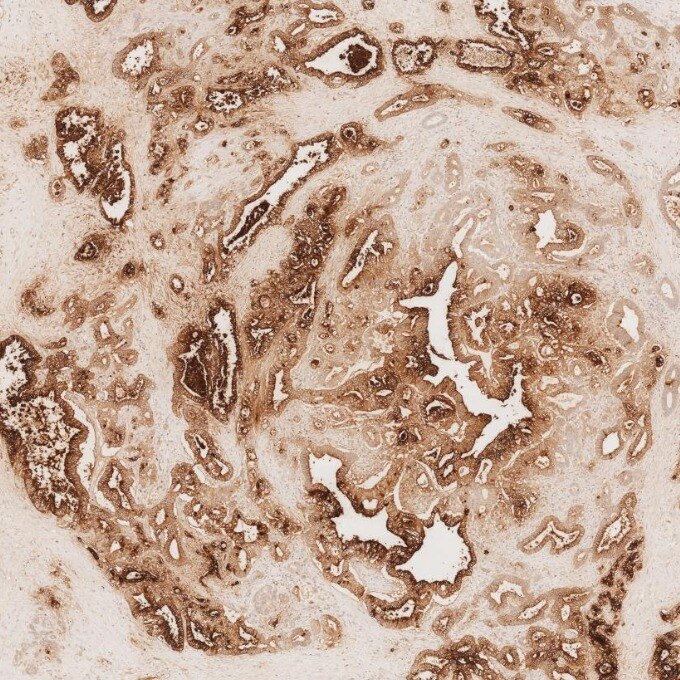 IHC staining of human pancreas cancer using 68377-1-Ig Immunohistochemistry (IHC) staining of human pancreas cancer tissue using CEA/CD66e Monoclonal antibody (68377-1-Ig)