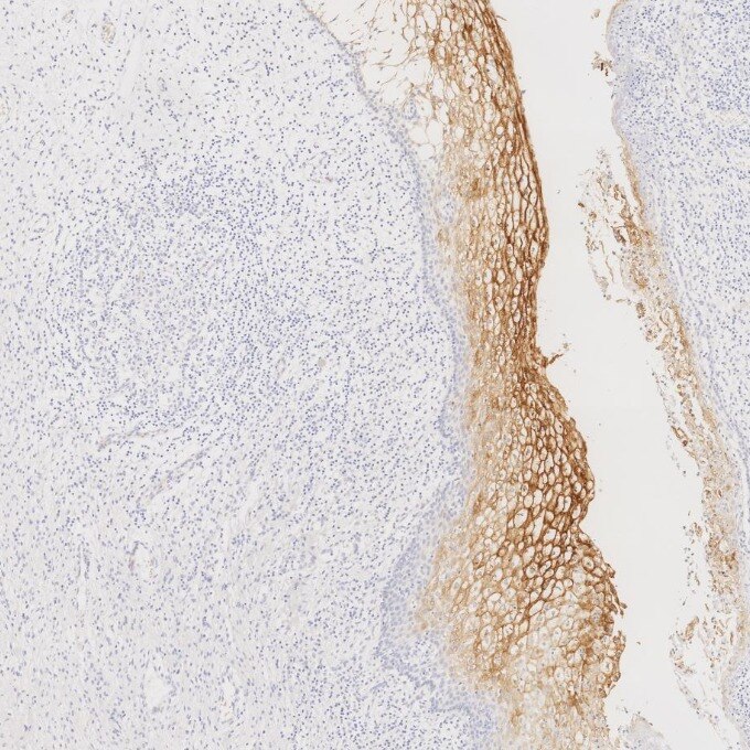 IHC staining of human cervical cancer using 68377-1-Ig Immunohistochemistry (IHC) staining of human cervical cancer tissue using CEA/CD66e Monoclonal antibody (68377-1-Ig)
