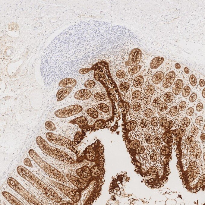 IHC staining of human large intestine using 68377-1-Ig Immunohistochemistry (IHC) staining of human large intestine tissue using CEA/CD66e Monoclonal antibody (68377-1-Ig)