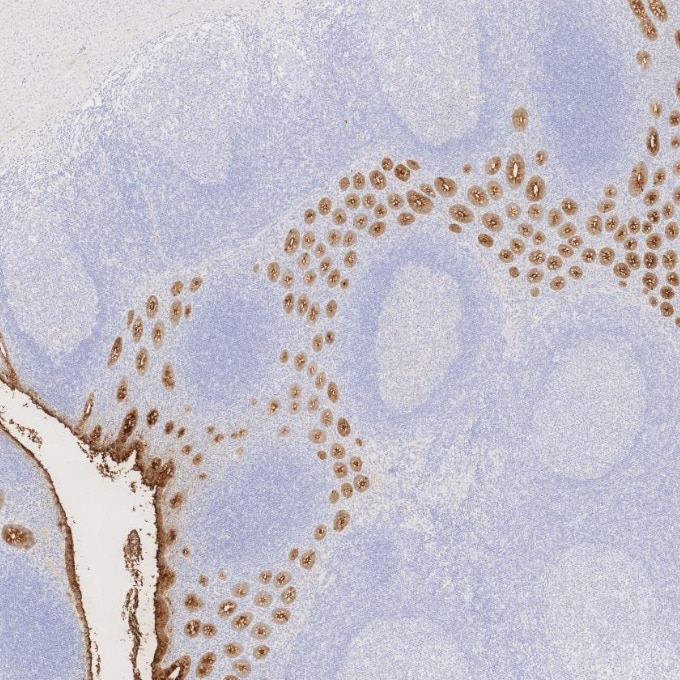 IHC staining of human appendicitis using 68377-1-Ig Immunohistochemistry (IHC) staining of human appendicitis tissue using CEA/CD66e Monoclonal antibody (68377-1-Ig)