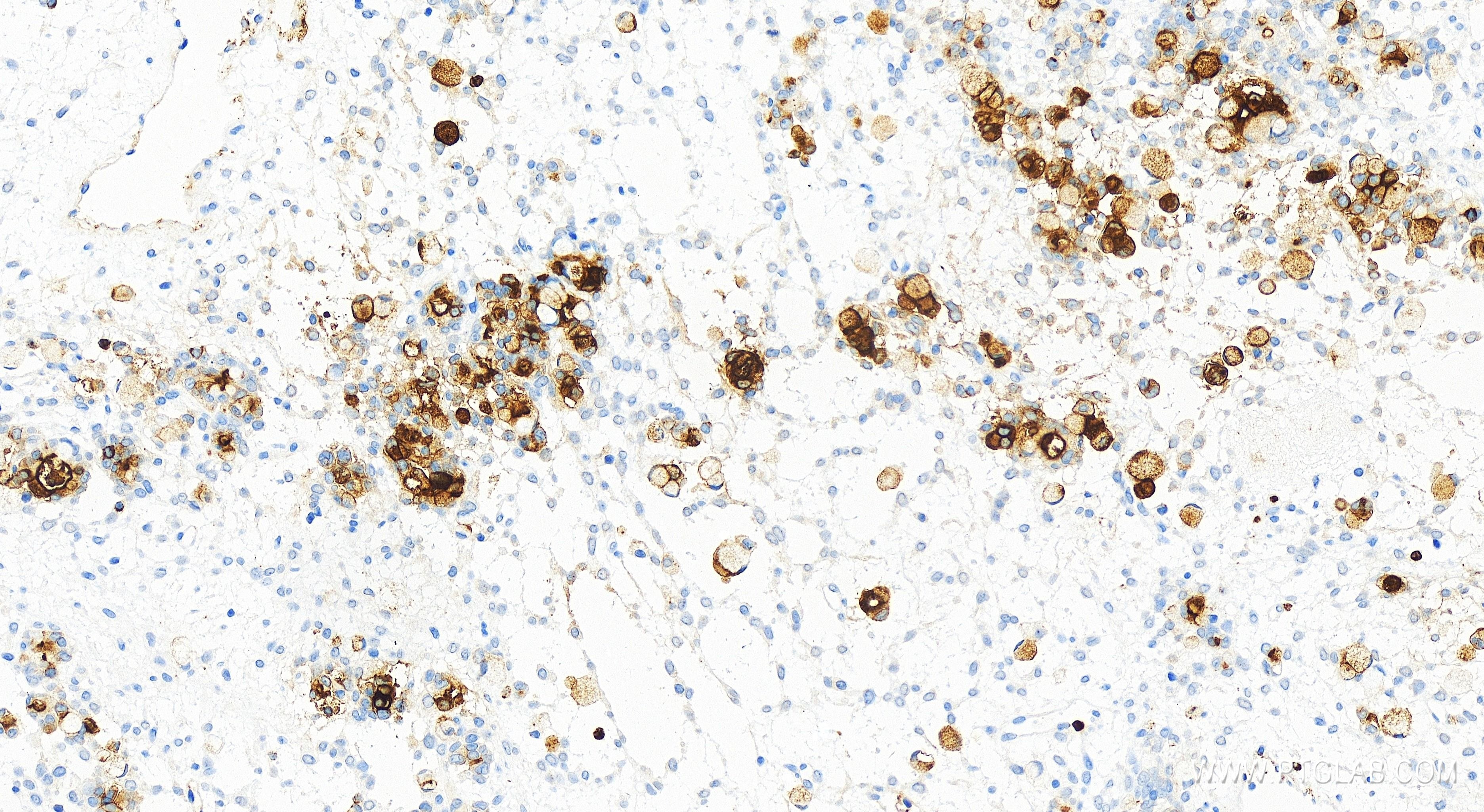 Immunohistochemistry (IHC) staining of human ovary cancer tissue using CEA/CD66e Recombinant antibody (83653-5-RR)