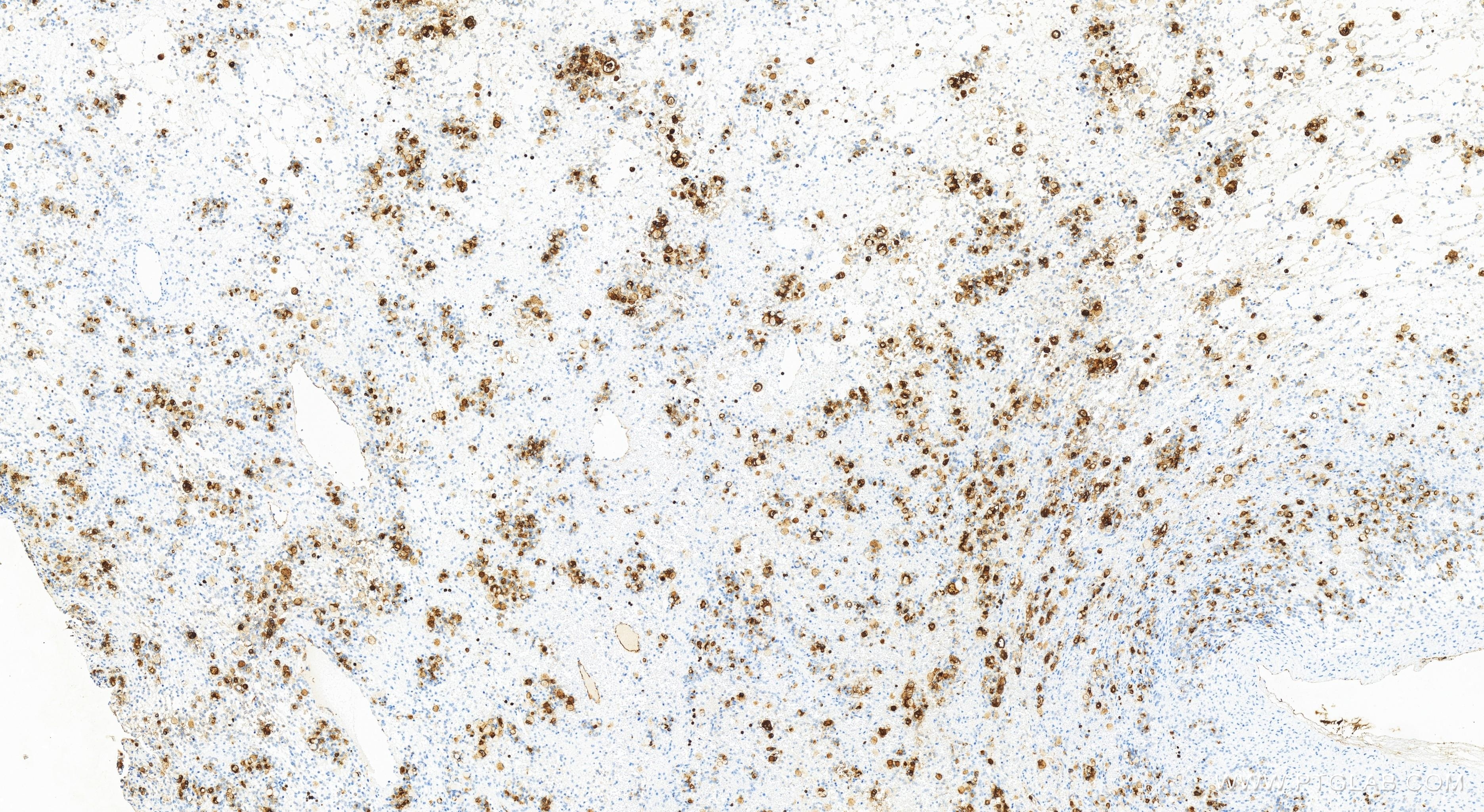 Immunohistochemistry (IHC) staining of human ovary cancer tissue using CEA/CD66e Recombinant antibody (83653-5-RR)