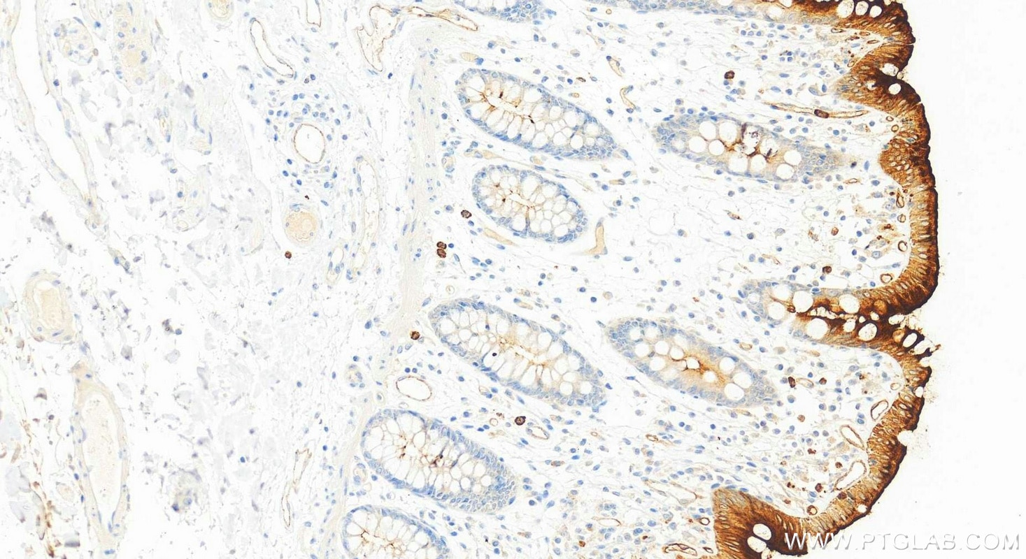 IHC staining of human colon using 83524-3-RR Immunohistochemistry (IHC) staining of human colon tissue using CEACAM1/3/6 (CD66a/c/d) Recombinant monoclonal ant (83524-3-RR)