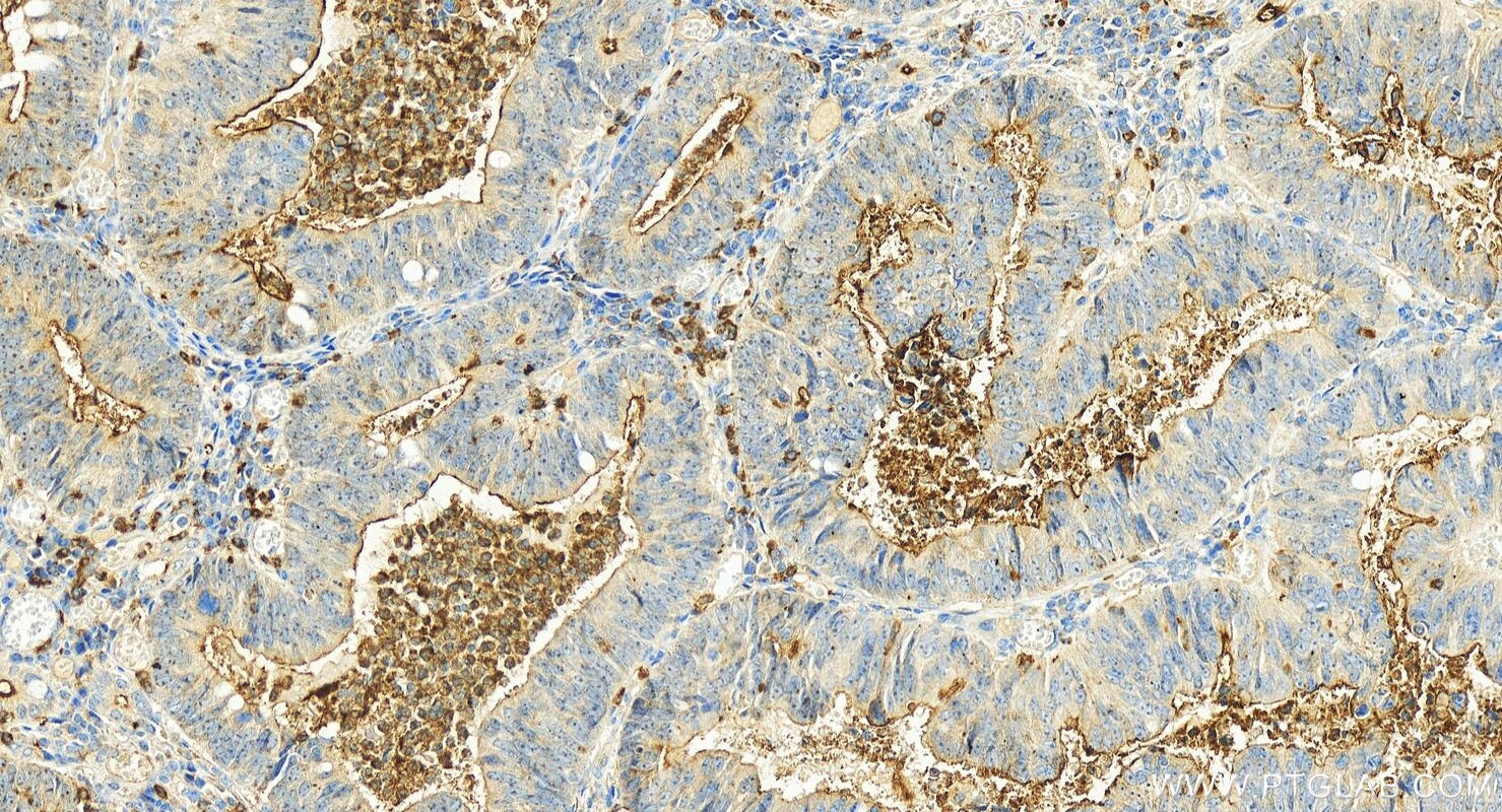 Immunohistochemistry (IHC) staining of human colon cancer tissue using CEACAM1/CD66a Polyclonal antibody (22238-1-AP)