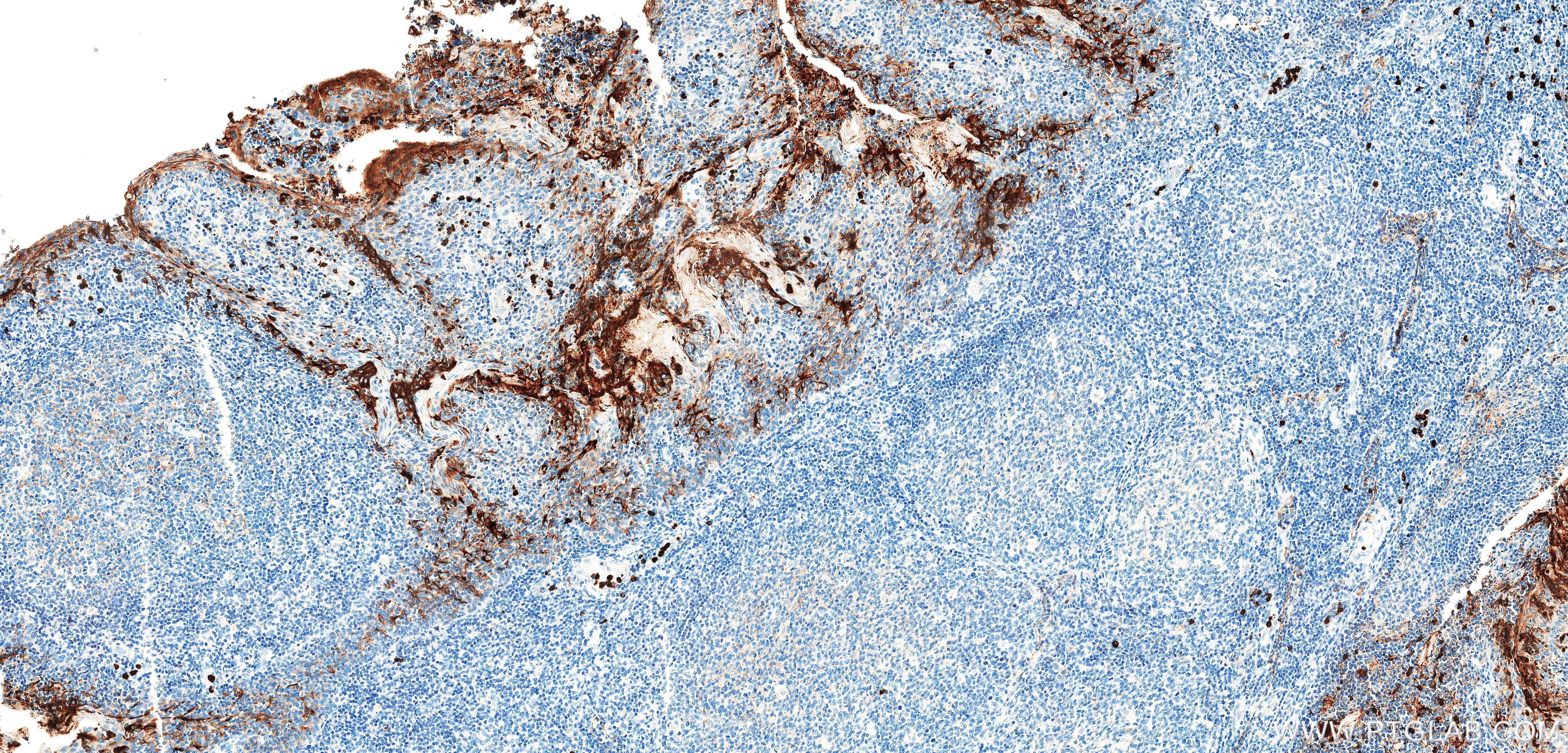 Immunohistochemistry (IHC) staining of human tonsil tissue using CEACAM1/CD66a Recombinant monoclonal antibody (83524-8-RR)