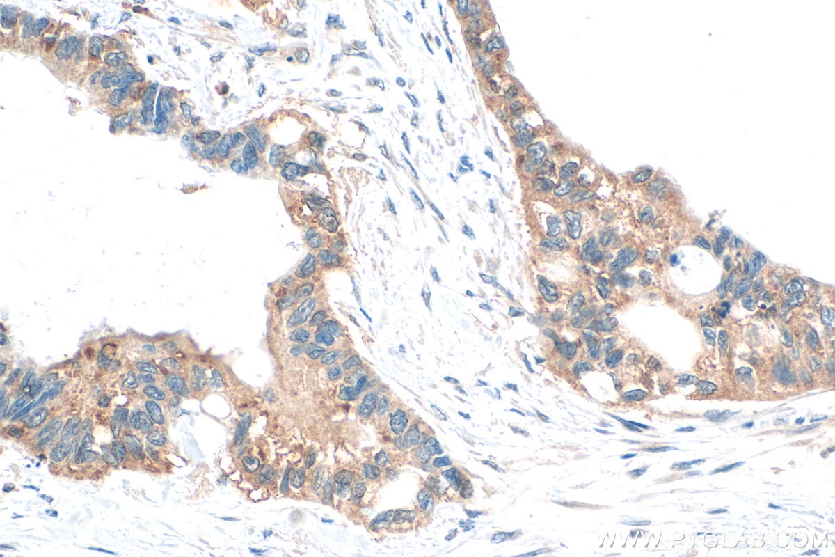 IHC staining of human urothelial carcinoma using 32196-1-AP (same clone as 32196-1-PBS) Immunohistochemistry (IHC) staining of human urothelial carcinoma tissue using CEACAM16 Polyclonal antibody (32196-1-AP)