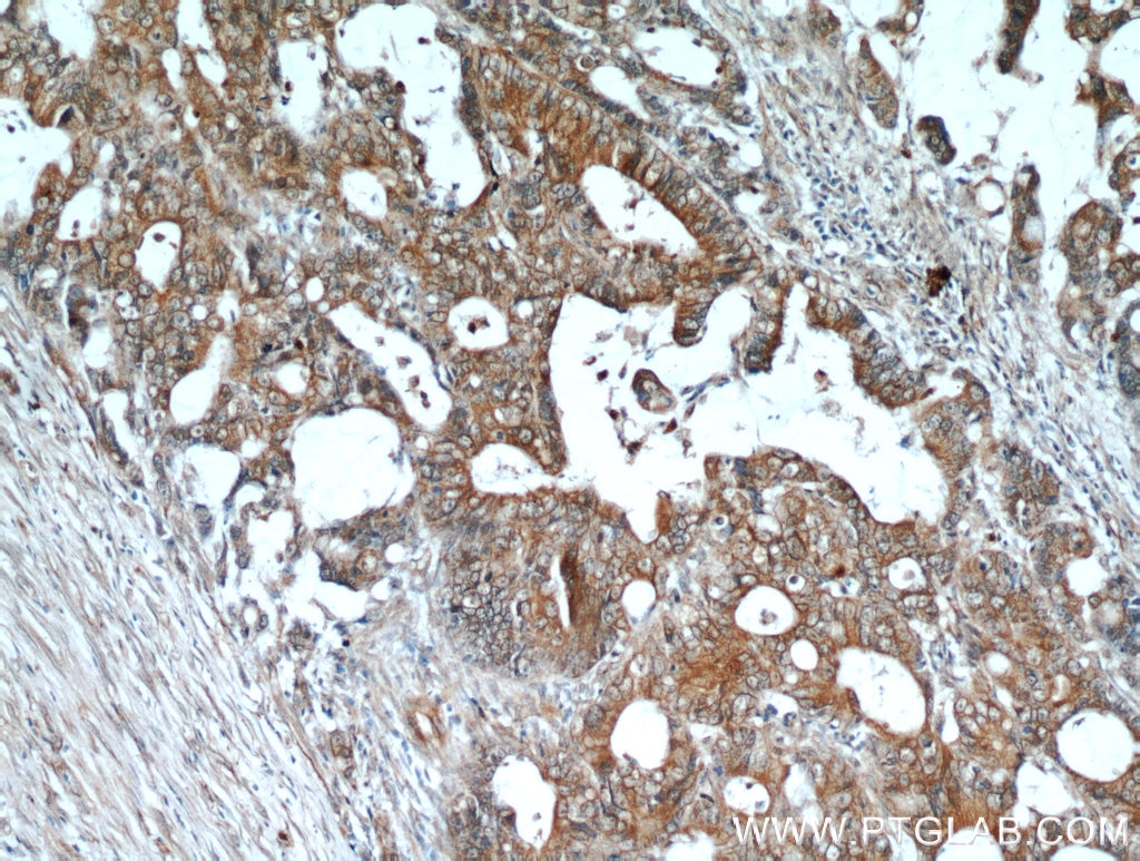 Immunohistochemistry (IHC) staining of human colon cancer tissue using CEACAM3-Specific Polyclonal antibody (19496-1-AP)