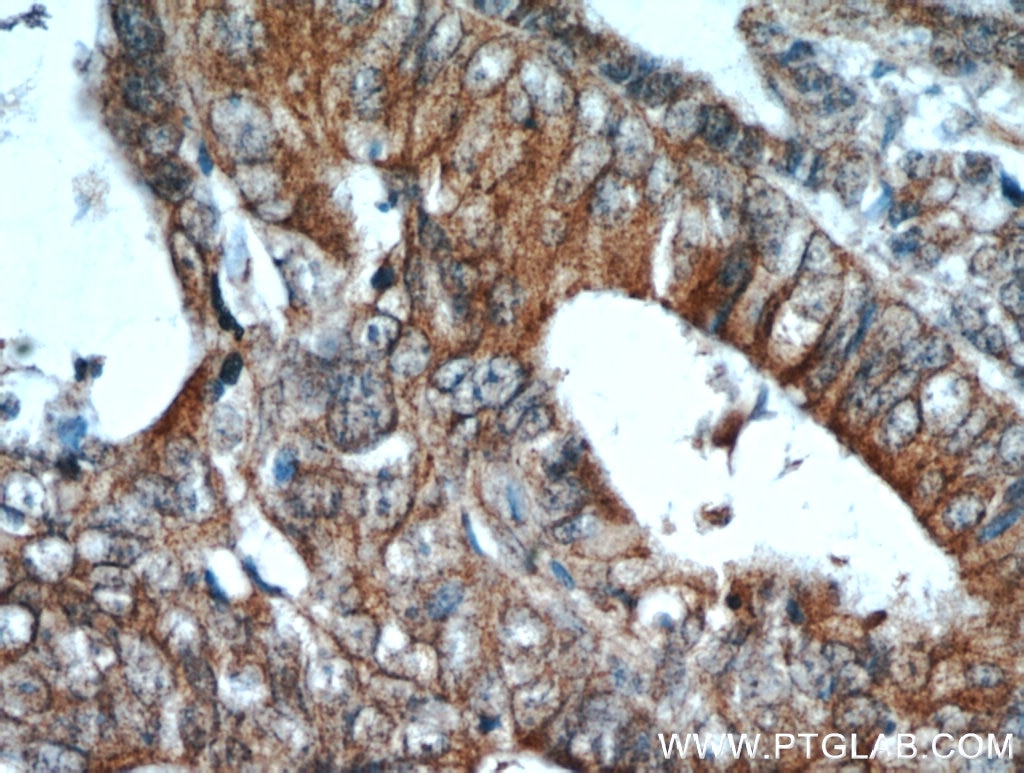 Immunohistochemistry (IHC) staining of human colon cancer tissue using CEACAM3-Specific Polyclonal antibody (19496-1-AP)