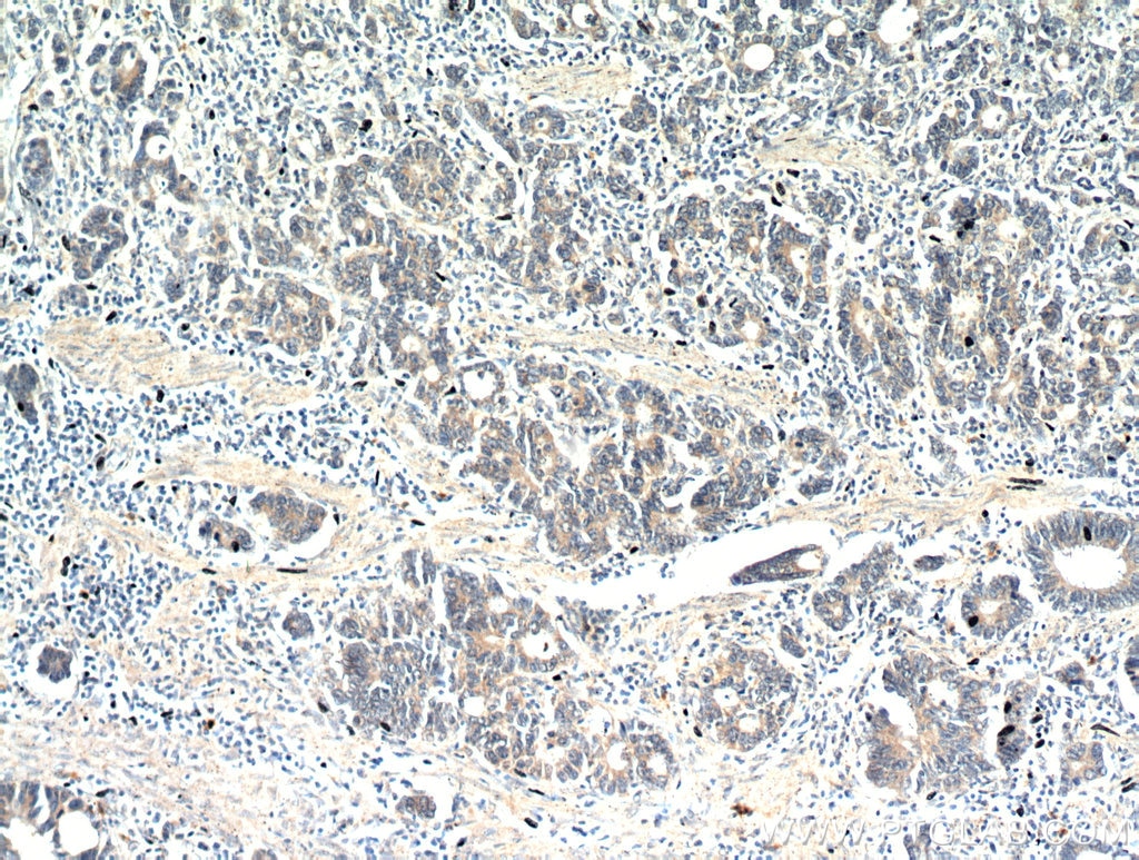 Immunohistochemistry (IHC) staining of human stomach cancer tissue using CEACAM3-Specific Polyclonal antibody (19496-1-AP)