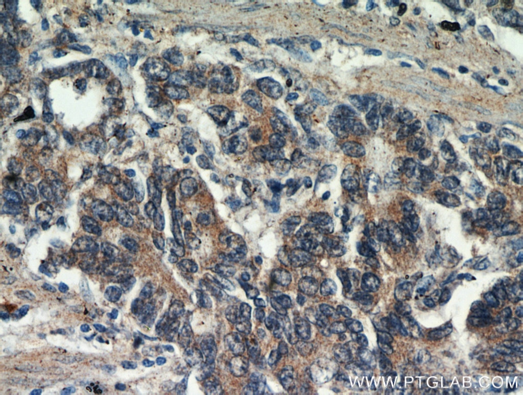 Immunohistochemistry (IHC) staining of human stomach cancer tissue using CEACAM3-Specific Polyclonal antibody (19496-1-AP)