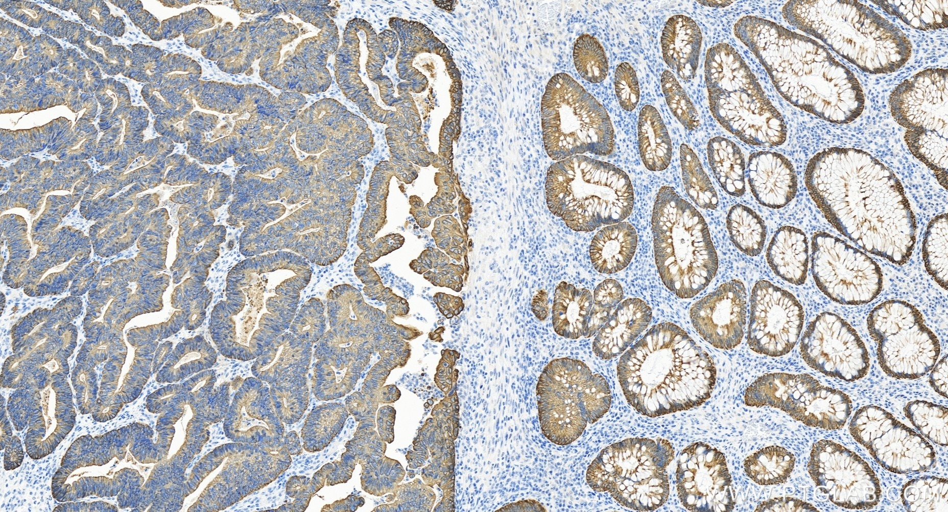 Immunohistochemistry (IHC) staining of human colon cancer tissue using CEACAM6/CD66c Recombinant antibody (84982-1-RR)