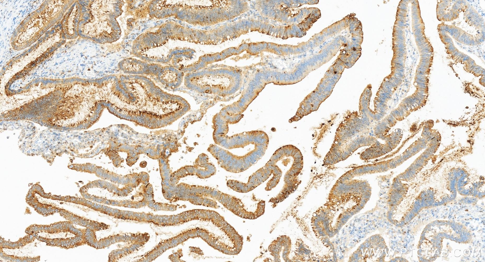 Immunohistochemistry (IHC) staining of human colon cancer tissue using CEACAM6 Recombinant antibody (84982-1-RR)