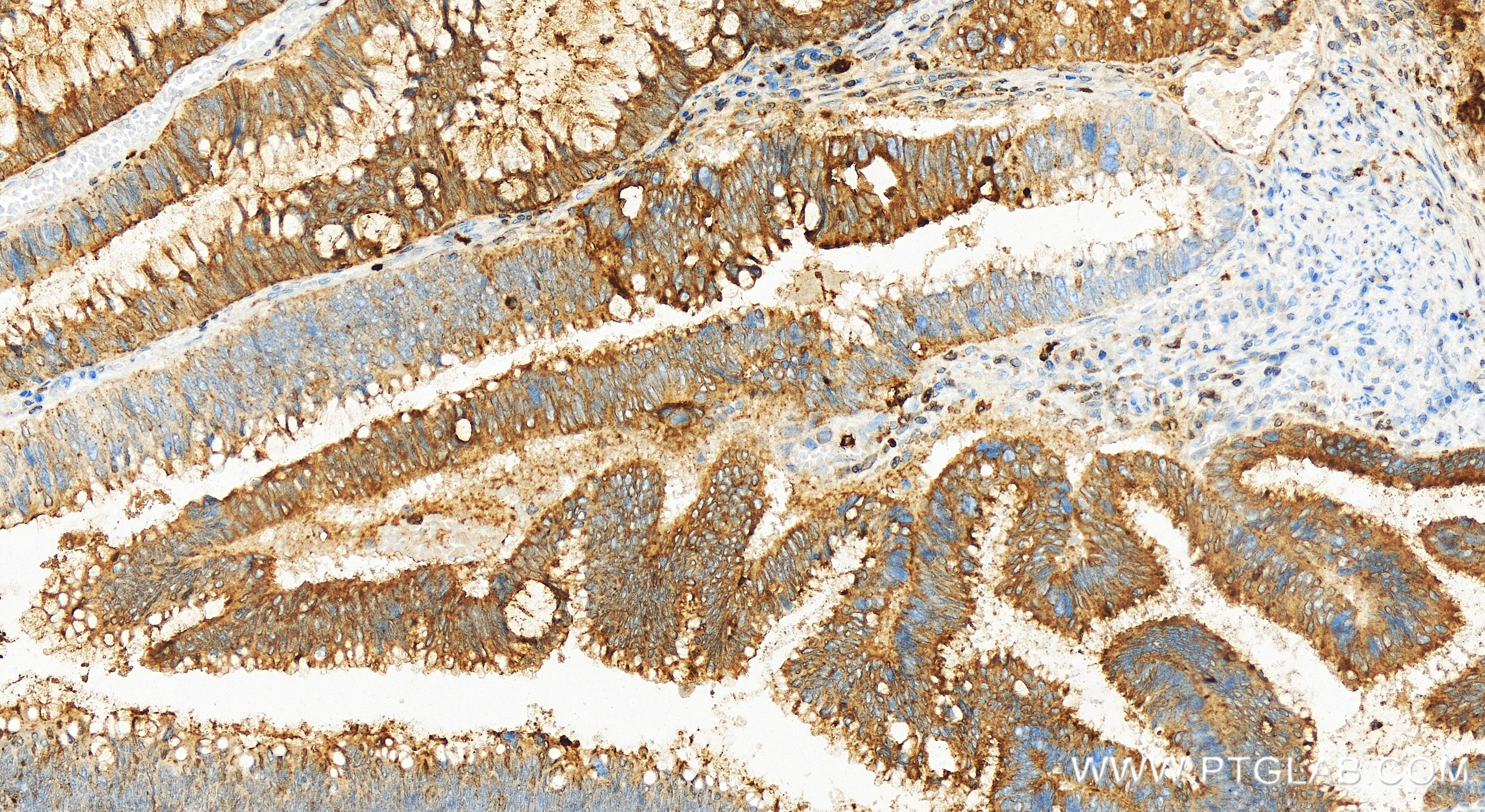 Immunohistochemistry (IHC) staining of human colon cancer tissue using CEACAM6 Recombinant antibody (84982-1-RR)