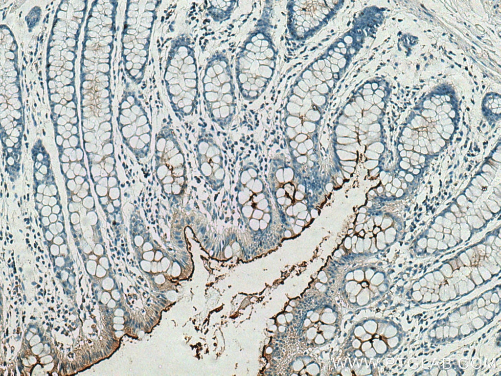 Immunohistochemistry (IHC) staining of human colon tissue using CEACAM7 Polyclonal antibody (24626-1-AP)
