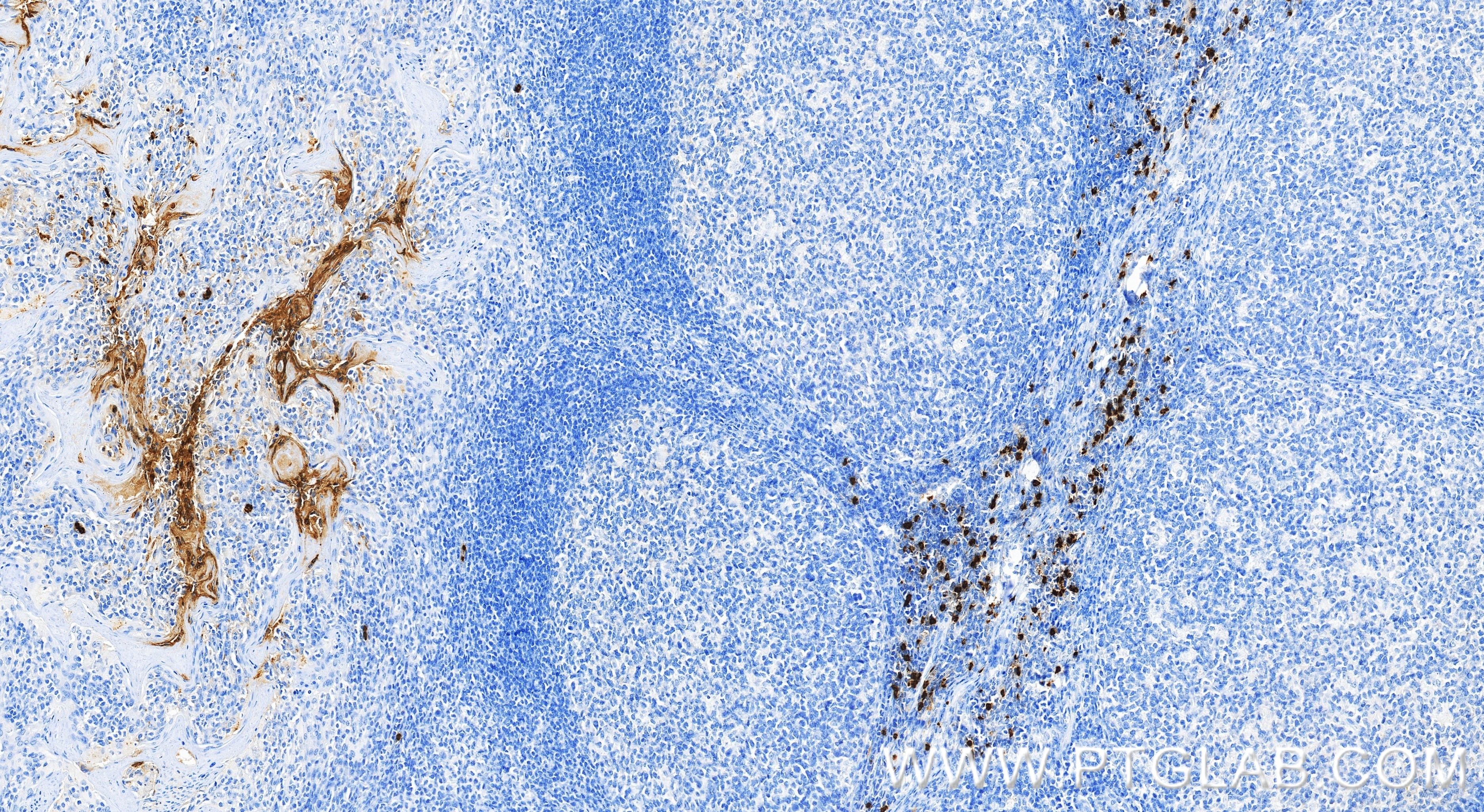 Immunohistochemical analysis of paraffin-embedded human tonsillitis tissue slide using 83105-6-RR (CEACAM8/CD66b antibody) at dilution of 1:10000 (under 20x lens). Heat mediated antigen retrieval with Tris-EDTA buffer (pH 9.0). Immunohistochemistry (IHC) staining of human tonsillitis tissue using CEACAM8/CD66b Recombinant monoclonal antibody (83105-6-RR)