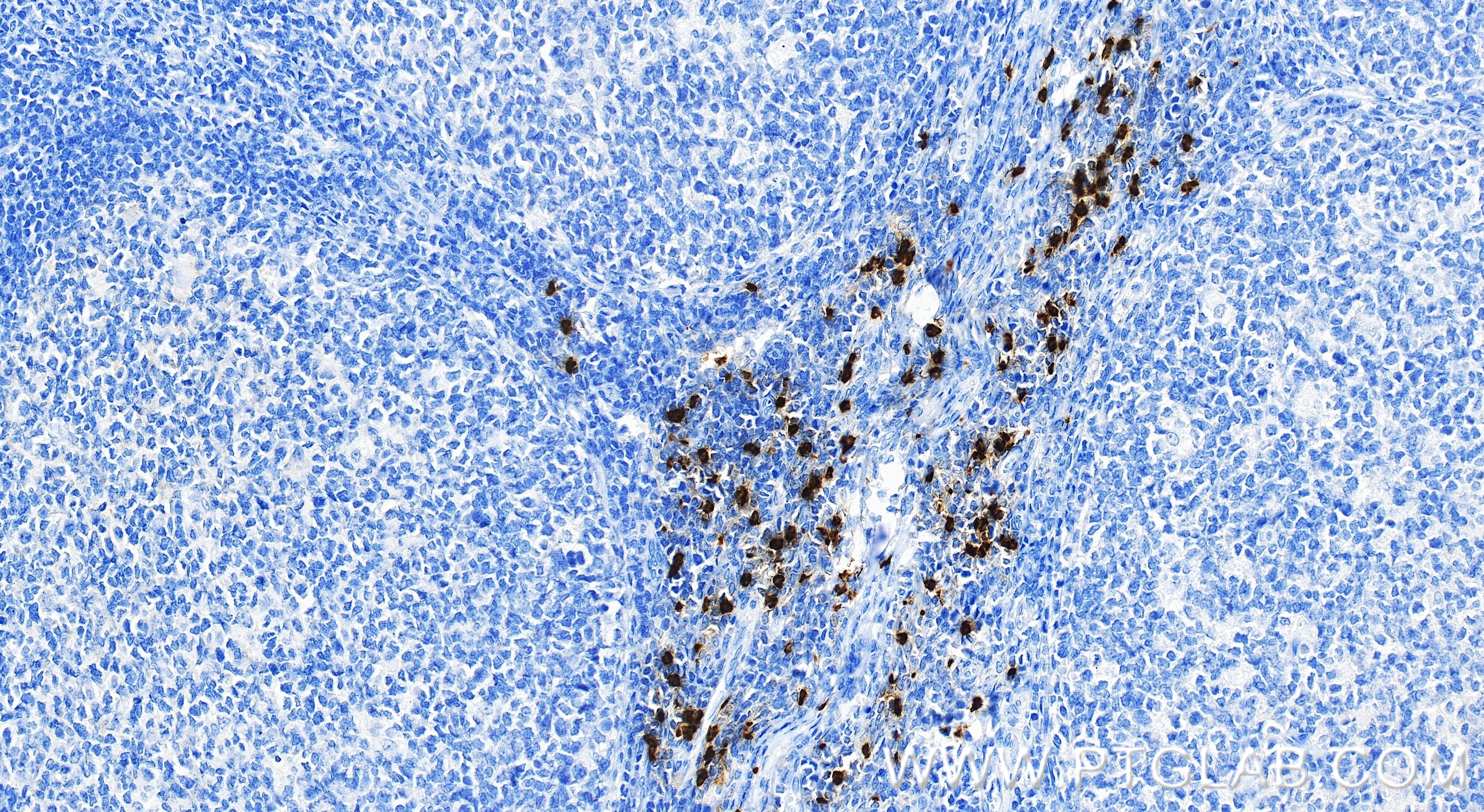Immunohistochemical analysis of paraffin-embedded human tonsillitis tissue slide using 83105-6-RR (CEACAM8/CD66b antibody) at dilution of 1:10000 (under 20x lens). Heat mediated antigen retrieval with Tris-EDTA buffer (pH 9.0). Immunohistochemistry (IHC) staining of human tonsillitis tissue using CEACAM8/CD66b Recombinant monoclonal antibody (83105-6-RR)