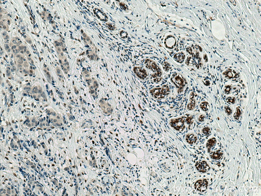 Immunohistochemistry (IHC) staining of human breast cancer tissue using CEBPB Polyclonal antibody (23431-1-AP)