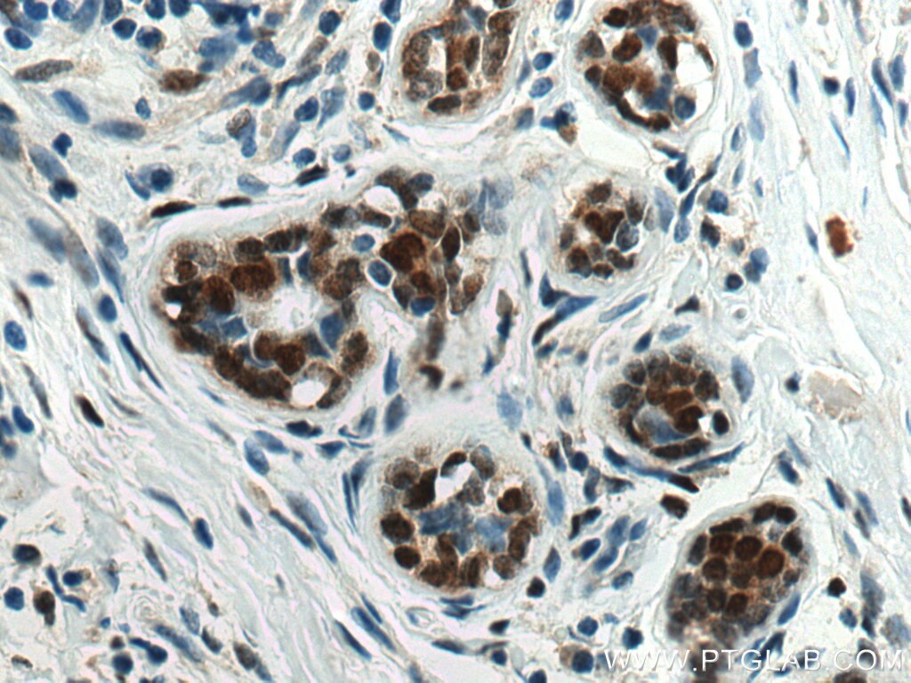 Immunohistochemistry (IHC) staining of human breast cancer tissue using CEBPB Polyclonal antibody (23431-1-AP)