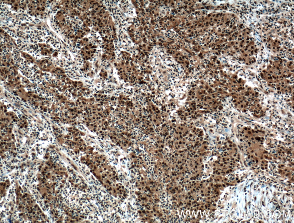 Immunohistochemistry (IHC) staining of human colon cancer tissue using CEBPB Polyclonal antibody (23431-1-AP)