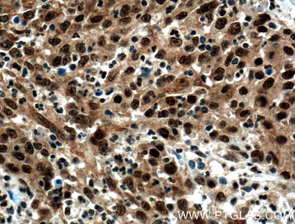 Immunohistochemistry (IHC) staining of human colon cancer tissue using CEBPB Polyclonal antibody (23431-1-AP)