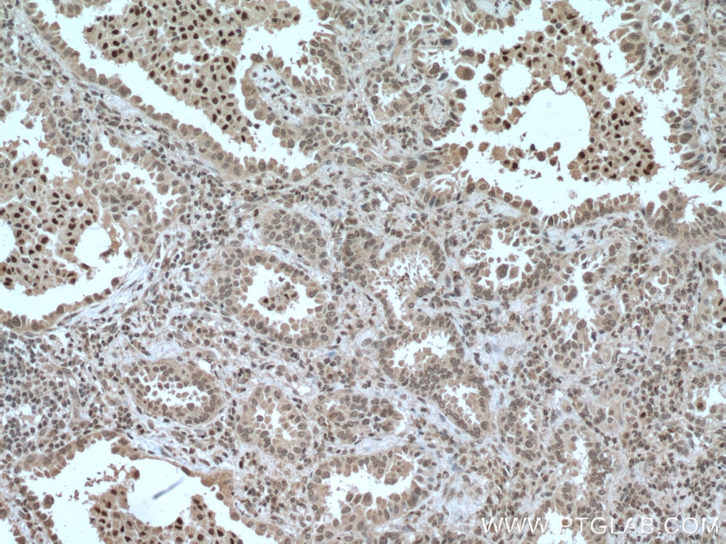 Immunohistochemistry (IHC) staining of human lung cancer tissue using CEBPB Monoclonal antibody (66649-1-Ig)