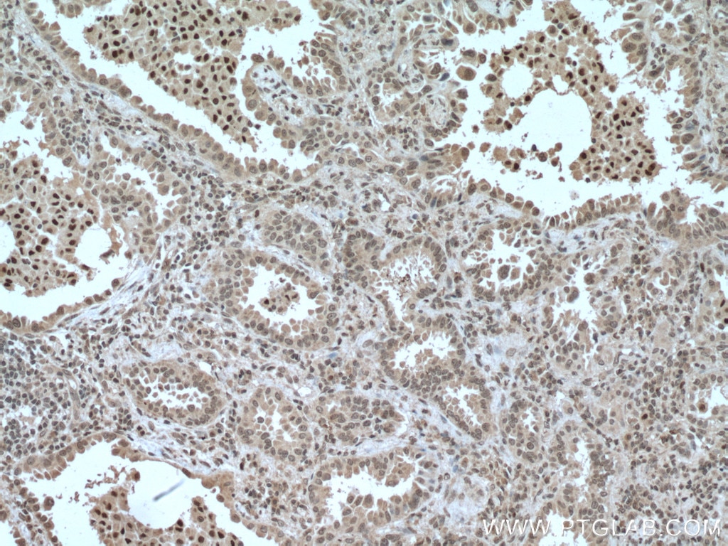 Immunohistochemistry (IHC) staining of human lung cancer tissue using CEBPB Monoclonal antibody (66649-1-Ig)
