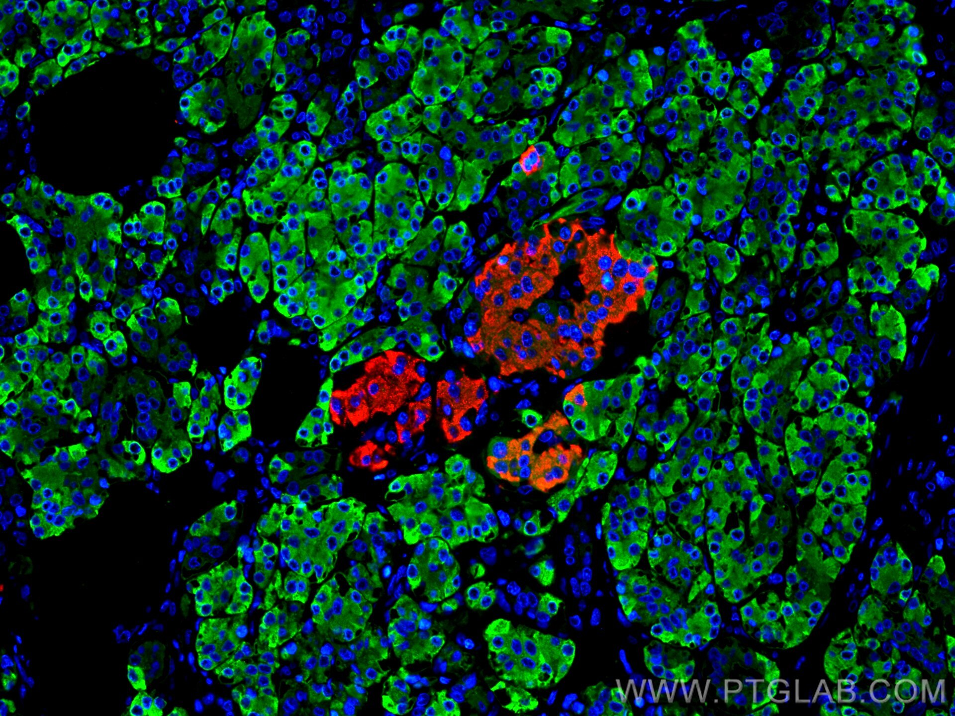Immunofluorescence (IF) / fluorescent staining of human pancreas cancer tissue using CEL Polyclonal antibody (15384-1-AP)