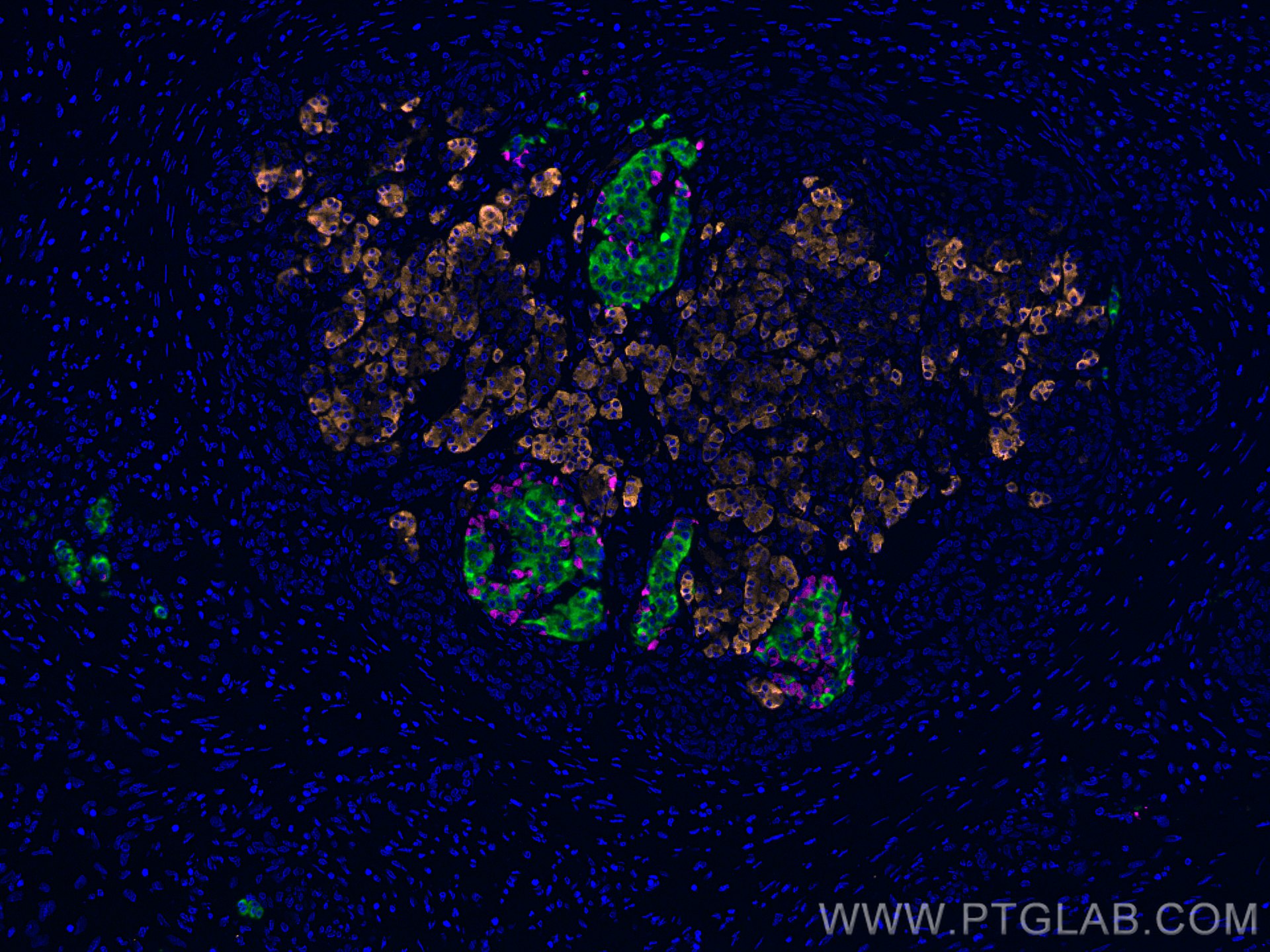 Immunofluorescence (IF) / fluorescent staining of human pancreas cancer tissue using CEL Polyclonal antibody (15384-1-AP)